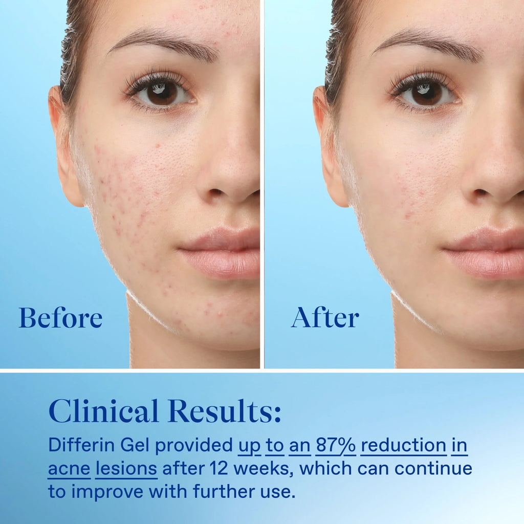 0.1% Adapalene Acne Treatment Gel D942840