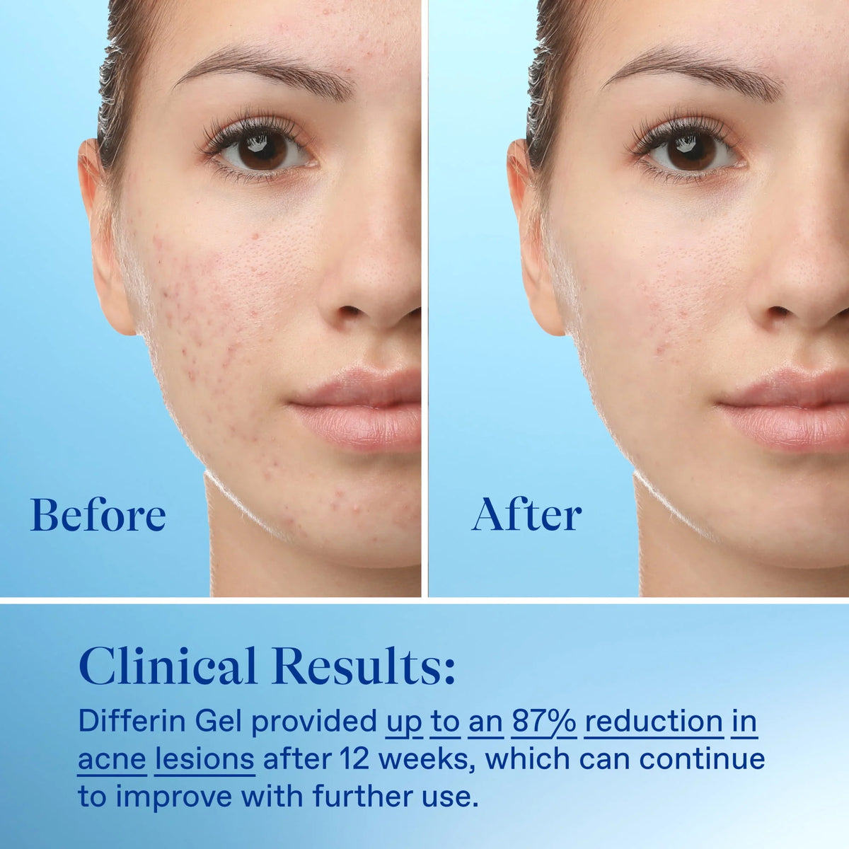 0.1% Adapalene Acne Treatment Gel D942840